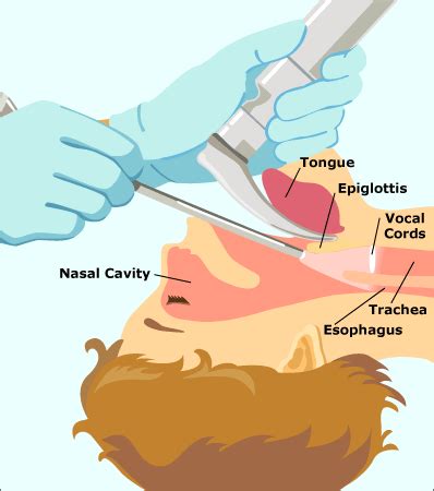 Laryngoscopy: Procedure, Definition & Types